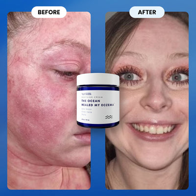 The Ocean Healed My Eczema