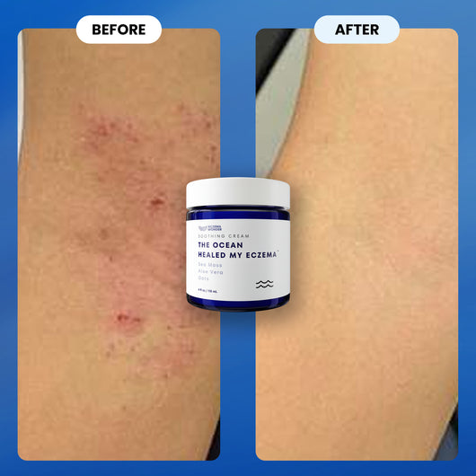 The Ocean Healed My Eczema