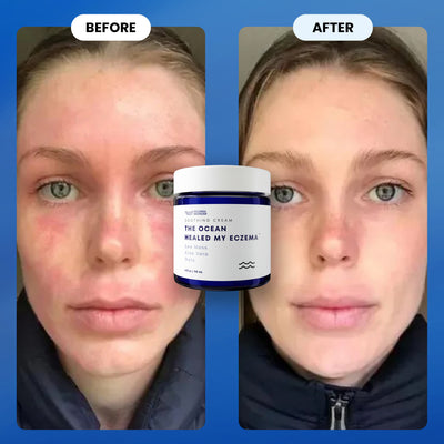 The Ocean Healed My Eczema