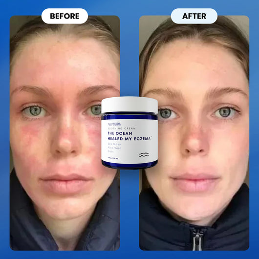 The Ocean Healed My Eczema