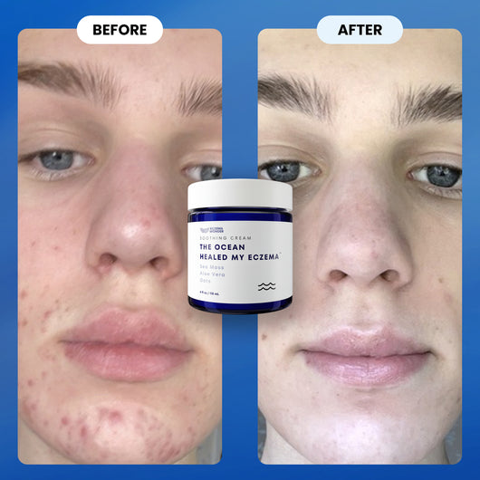 The Ocean Healed My Eczema